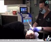 https://www.baumanmedical.com/smartgraft-fue-hair-transplant-nbc/nnWatch Brian&#39;s SmartGraft FUE Hair Transplant story as seen on NBC6 6-In-The-Mix in Miami Florida.nBrian received his no-linear-scar minimally-invasive hair transplant from hair loss expert and full-time ABHRS certified surgeon, Dr. Alan Bauman in Boca Raton, FL. How did Brian&#39;s hair transplant transform him? How did it feel to undergo the procedure? Was it painful or pluggy? How natural does the result look? Find out the answers