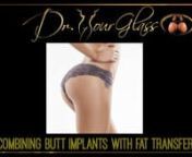Hi, this is Dr. Hourglass, and welcome to another video in our channel Bootyman. Today we are going to discuss: Combining butt implants with fat transfer.In this channel, we will discuss everything you need to know about buttock enhancement procedures.nWelcome back!Many patients come to my clinic and ask me which one is the best procedure for them: butt implants or fat transfer. While many tend to be more interested in fat transfer, there are others who are aware of the undeniable benefits o