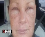 A woman&#39;s face swelled up like balloon after she suffered second and third degree burns when her pressure cooker exploded - while cooking soup. &#60;br/&#62;&#60;br/&#62;Becky Fargo, 43, was cooking potato soup for her daughter Jadyn Young, 13, when the pressure cooker pressurized unexpectedly and exploded. &#60;br/&#62;&#60;br/&#62;Becky, of South Webster, Ohio, USA, had set the machine to cook without pressure, something she had done several times before.&#60;br/&#62;&#60;br/&#62;But when she tried to get the soup out, the cooker exploded leaving 2nd and 3rd degree burns on her face, chest and neck.&#60;br/&#62;&#60;br/&#62;Becky, a restaurant manager, said: &#92;