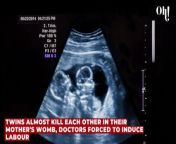 Twins almost kill each other in their mother's womb, doctors forced to induce labour from nangi soti girl forced in