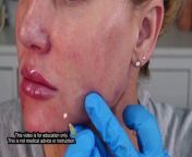 Using threads to build natural collagen and give a non invasive lift to the face is easier than you might think. High quality threads available at Acecosm.com Discount code STACY10&#60;br/&#62;&#60;br/&#62;PRODUCTS MENTIONED IN THIS VIDEO&#60;br/&#62;Screw PDO Threads https://tinyurl.com/5e62f8fz Discount Code STACY10&#60;br/&#62;Numbing Cream: https://tinyurl.com/2m2wnuzr Discount Code STACY10&#60;br/&#62;&#60;br/&#62;Thank you so much for watching! Be a part of the Gorgeously Aging community by subscribing below! xo Stacy&#60;br/&#62;&#60;br/&#62;FIND ME ON ALL SOCIALS @gorgeouslyaging &#60;br/&#62;&#60;br/&#62;LET&#39;S STAY CONNECTED! Sign up for the Gorgeously Aging DIY educational content: &#60;br/&#62;https://tinyurl.com/3nuv7fms&#60;br/&#62;&#60;br/&#62;For PR Inquiries: &#60;br/&#62;Send an email to stacy@gorgeouslyaging.com.&#60;br/&#62;&#60;br/&#62;LTK LINKS:https://www.shopltk.com/explore/gorgeouslyaging&#60;br/&#62;&#60;br/&#62;Everything in ONE SPOT here: https://www.direct.me/GorgeouslyAgingNote: You can subscribe to my Direct Me Page at the link above to stay updated on newest products, educational videos, and discounts!&#60;br/&#62;&#60;br/&#62;——— MY AMAZON SHOP ———&#60;br/&#62;https://tinyurl.com/5n8nt9uh&#60;br/&#62;&#60;br/&#62;☕FUEL THE CONTENT! Buy me a coffee here: https://www.buymeacoffee.com/GorgeouslyAging&#60;br/&#62;&#60;br/&#62;For more information about products I use and love, please go to https://www.GorgeouslyAging.com for details. &#60;br/&#62;&#60;br/&#62;&#36;&#36;&#36;&#36; DISCOUNT CODES TO SAVE &#36;&#36;&#36;&#36;&#60;br/&#62;Find more discount codes and favorite products at https://www.gorgeouslyaging.com/vendors-discount-codes/&#60;br/&#62;&#60;br/&#62;Nira Laser &#60;br/&#62;https://tinyurl.com/atesr38m - Code STACY10 FOR 10% off&#60;br/&#62;&#60;br/&#62;Platinum Skin Care&#60;br/&#62;https://platinumskincare.com - Code STACY10&#60;br/&#62;&#60;br/&#62;Plasma Perfecting&#60;br/&#62;https://plasmaperfecting.com - Code STACY100 for Plasma Pens, STACY500 for RF Microneedling Device &amp; Larger Machines&#60;br/&#62;&#60;br/&#62;Skin Store&#60;br/&#62;https://tidd.ly/3pJcOeG - Code STACY for 25% Off (some exclusions)&#60;br/&#62;&#60;br/&#62;Style Vana&#60;br/&#62;https://stylevana.com - Code INF10STACY for 10% off&#60;br/&#62;&#60;br/&#62;Yesoul Fitness&#60;br/&#62;https://yesoulfitness.com- Code STACY100 for &#36;100 off&#60;br/&#62;&#60;br/&#62;+++SUGGESTED DEVICES ++++&#60;br/&#62;Dr. Pen M8 https://amzn.to/3rytGXc&#60;br/&#62;Fractional RF Microneedling Machine https://tinyurl.com/bdcv3erc Discount Code STACY500 for &#36;500 Off&#60;br/&#62;Magelin RF &amp; Microcurrent Device https://tinyurl.com/4z6axn79 Discount code STACY10&#60;br/&#62;Plaxel+ Professional Plasma Pen https://tinyurl.com/47snn9yc Discount code STACY100 for &#36;100 Off and FREE certification &#60;br/&#62;Current Body LED Mask https://tidd.ly/3FhNvKi&#60;br/&#62;JOVS Blacken Photorejuvenation Device https://tinyurl.com/yckz4mwm Discount code KGA70B&#60;br/&#62;&#60;br/&#62;Books&#60;br/&#62;Tox Journal &amp; Education https://amzn.to/3SHpBht&#60;br/&#62;Thread Lifting Textbook https://amzn.to/3ZUXcb2&#60;br/&#62;Dermal Filler Procedures https://amzn.to/46l78Nr&#60;br/&#62;The Korean Skincare Biblehttps://amzn.to/3FfkxKX&#60;br/&#62;Skin Revolution https://amzn.to/3RYB1Pb&#60;br/&#62;Skincare Decoded https://amzn.to/46teWNf&#60;br/&#62;&#60;br/&#62;➡️ Credentials: Cosmetology Degree 1991, Advanced Aesthetics Training 2001-2003,Owner of Styles Salon &amp; Spa 1991-2011, Owner Studio 262 Salon &amp; Spa 2009-2011, Anatomy &amp; Massage Therapy 2006, Permanent Cosmetics Certification 2006,Owner Madison Permanent Cosmetics 2012-2022, Fibroblast Certification 2022, Master Aesthetician 2023, Medical Aesthetician 2023