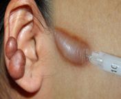 Keloids In Ears: कई जाने-अनजाने लोगों को चोट या खरोंच लग जाती है। वैसे तो समय के साथ चोट के घाव भर जाते हैं, लेकिन कई बार इन घावों के निशान स्किन पर बने रह जाते हैं। कई बार यह स्कार बढ़ने लगते हैं और चर्बी की गांठ की तरह बन जाते हैं। इसे केलॉइड कहा जाता है। केलॉइड किसी चोट या कट के निशान से बना घाव का निशान है, जो समय के साथ एक बड़ा निशान और गांठ की तरह दिख सकता है। अक्सर यह घाव छाती, बांह, हाथ की ऊपरी हिस्से पर देखने को मिलता है। इस लेख में आपको कान के पास होने वाले केलॉइड्स के बारे में बताएंगे। साथ ही, इसके मुख्य कारण और इलाज के तरीके को भी बताया गया है। &#60;br/&#62; &#60;br/&#62;Keloids In Ears: Many people get hurt or scratched knowingly or unknowingly. Although the wounds heal with time, many times the marks of these wounds remain on the skin. Sometimes these scars start growing and become like lumps of fat. This is called keloid. A keloid is a scar formed from an injury or cut, which may look like a large scar and lump over time. Often this wound is seen on the chest, arm and upper part of the hand. In this article we will tell you about keloids occurring near the ears. Besides, its main causes and methods of treatment have also been explained. &#60;br/&#62; &#60;br/&#62;#earkeloidtreatmentathome #earkeloidhomeremedies #earkeloidremoval #earkeloidremedies #earkeloidnewstoday &#60;br/&#62;~PR.111~ED.118~