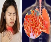 Dry cough causes in hindi: आपने देखा होगा कि आपके आस-पास कुछ ऐसे लोग होंगे जिन्हें रह-रह कर खांसी आती है। दरअसल, ये लोग सूखी खांसी की समस्या से परेशान होते हैं। इस खांसी में कफ या बलगम नहीं आता है। होता ये है कि आपके फेफड़ों और गले में एक गुदगुदी पैदा होती है जो अक्सर गले में जलन और खुजली का कारण बनती है। इसमें हर समय ऐसा लगता है कि गले या सांस की नलियों में कुछ फंसा हुआ है और इसी चक्कर में लोग बार-बार सूखी खांसी करते हैं। ज्यादातर इन 4 समस्याओं वाले लोगों में ये चीज ज्यादा देखी जाती है। कैसे, जानते हैं। &#60;br/&#62; &#60;br/&#62;Dry cough causes in Hindi: You must have noticed that there are some people around you who cough from time to time. Actually, these people are troubled by the problem of dry cough. There is no phlegm or mucus in this cough. What happens is that a tickling occurs in your lungs and throat, which often causes a burning sensation and itching in the throat. In this, it always seems that something is stuck in the throat or respiratory tubes and due to this, people repeatedly have dry cough. This thing is mostly seen in people with these 4 problems. How, we know... &#60;br/&#62; &#60;br/&#62; &#60;br/&#62;#Drycough#cough&#60;br/&#62;~PR.115~ED.284~